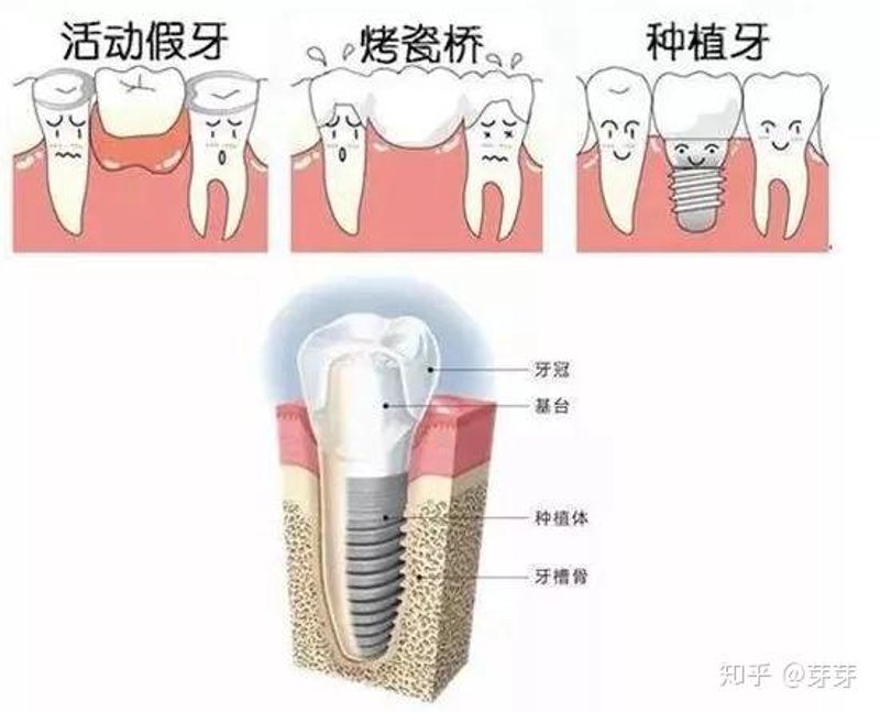 抚州牙齿种植